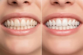 Как часто нужно делать профессиональную гигиену полости рта