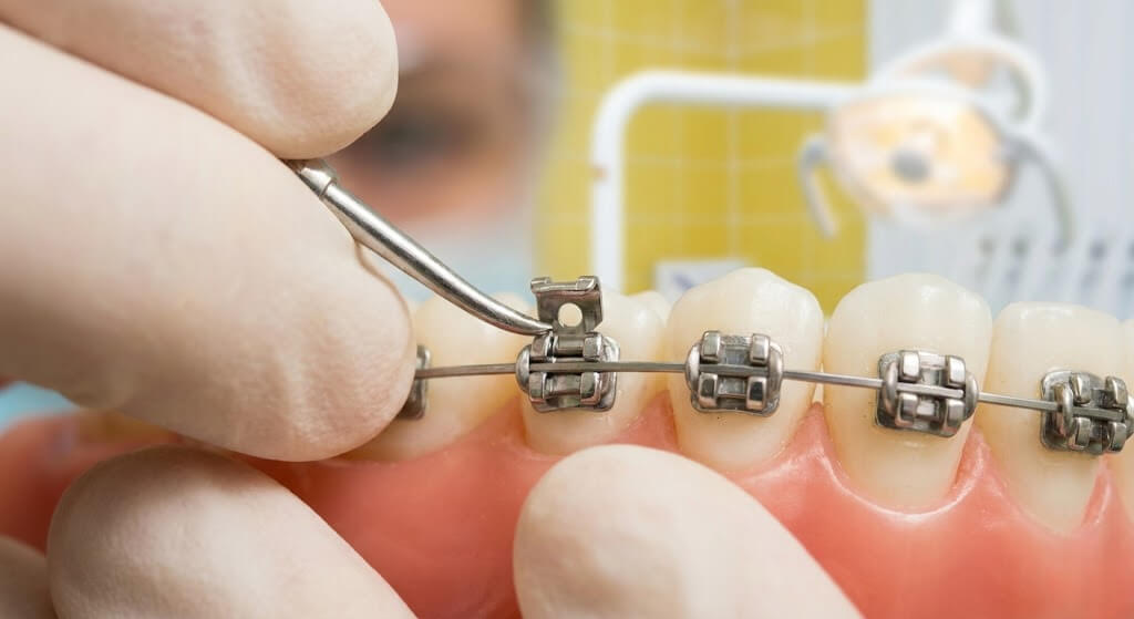 Принцип работы безлигатурных брекетов