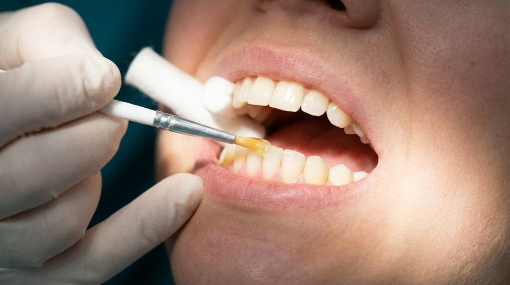 Фторирование зубов для укрепления после чистки