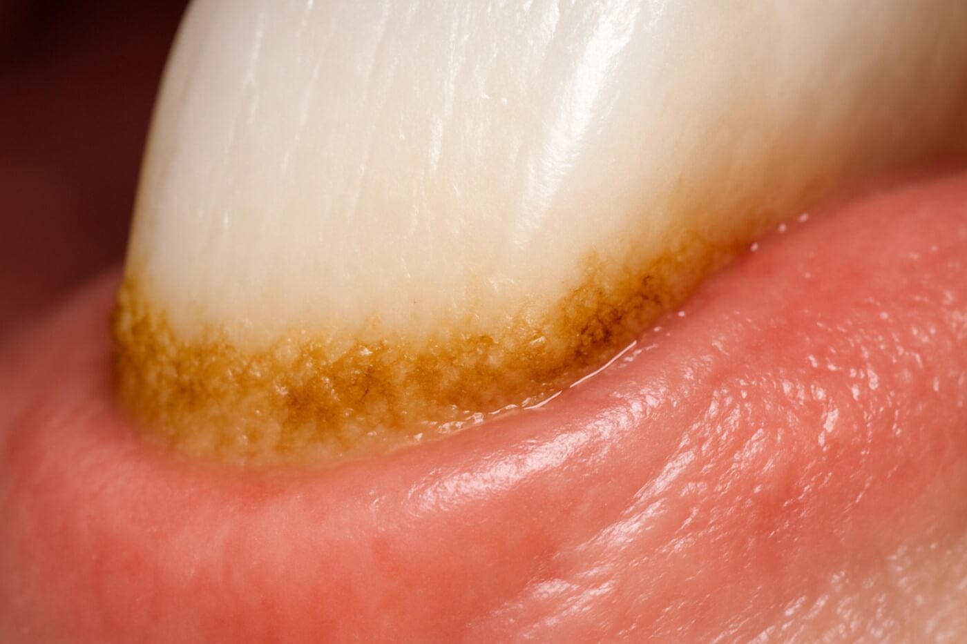 Макро-снимок зубного камня у десны